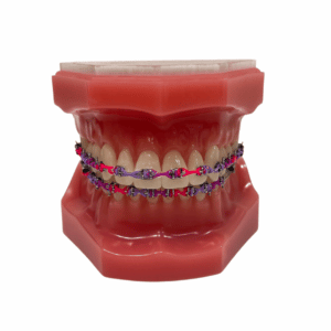 Metal Braces - SOCO Pediatric Dentistry & Orthodontics